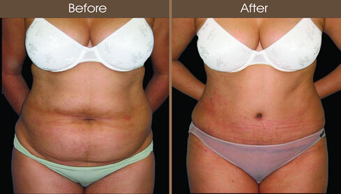 20122210155826_abdom_5_front